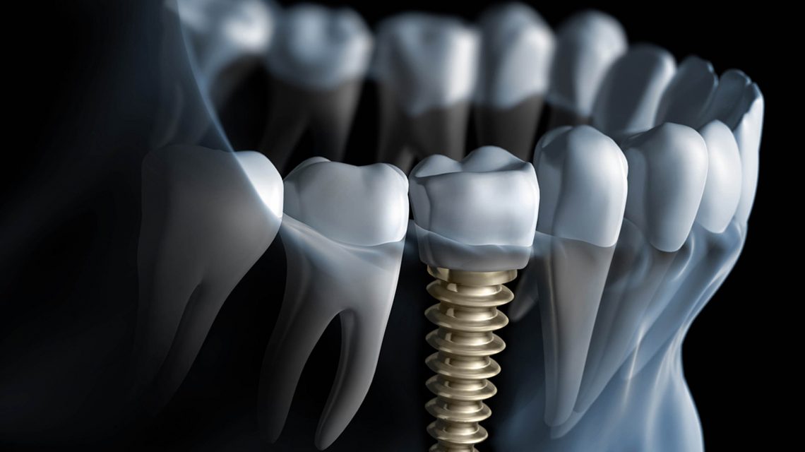 implant-ustu-dis