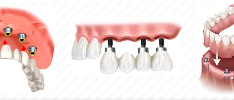 tam-dissiz-hastalarda-implant