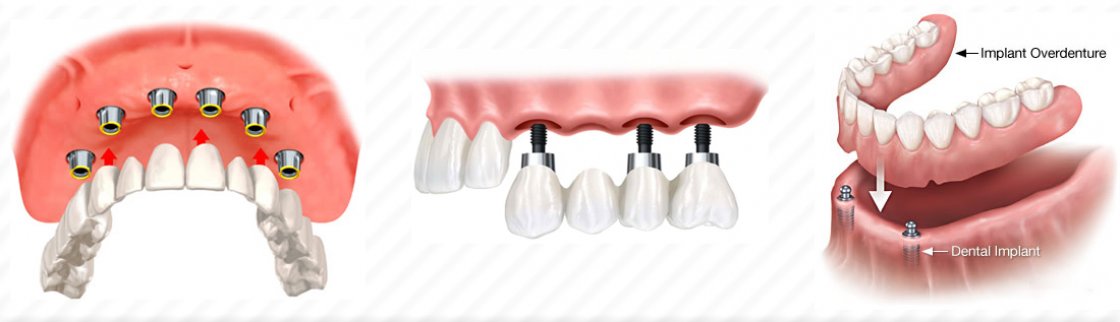 tam-dissiz-hastalarda-implant