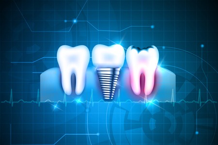 dental implant