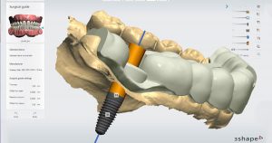 robotik-implant
