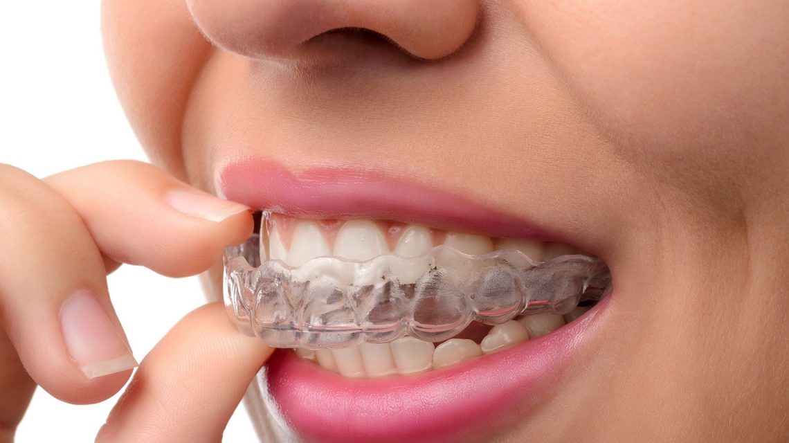 Invisalign