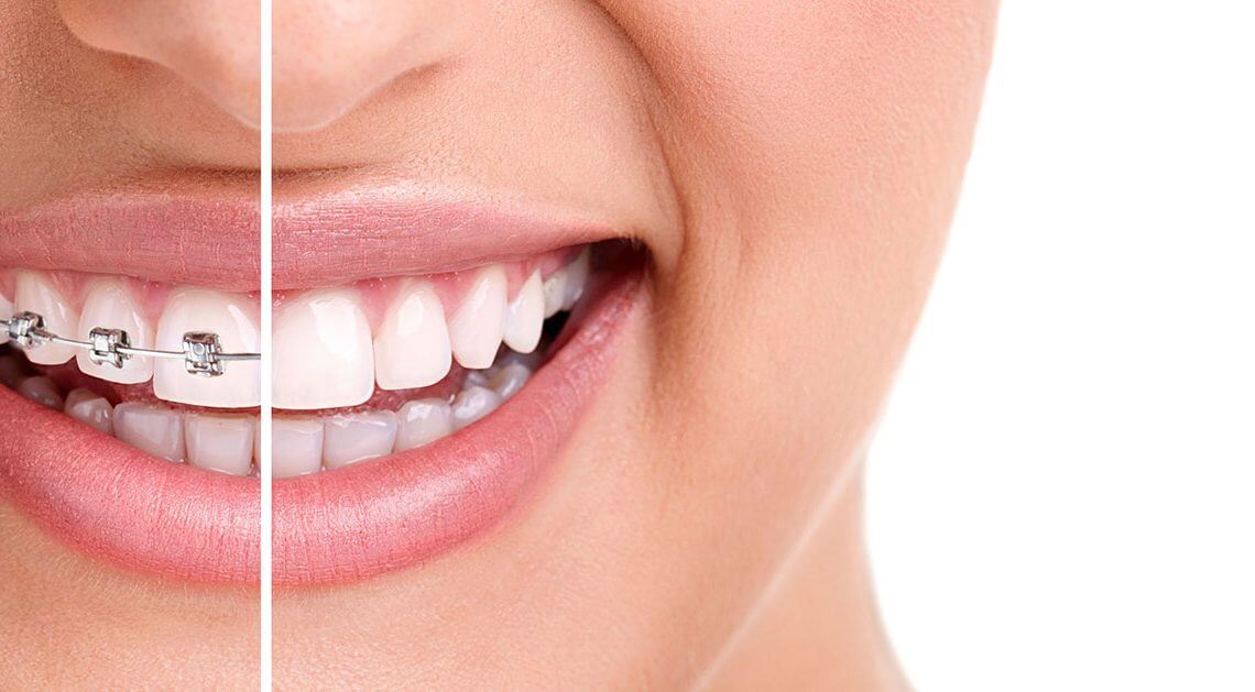 Hızlı Diş Teli Tedavisi