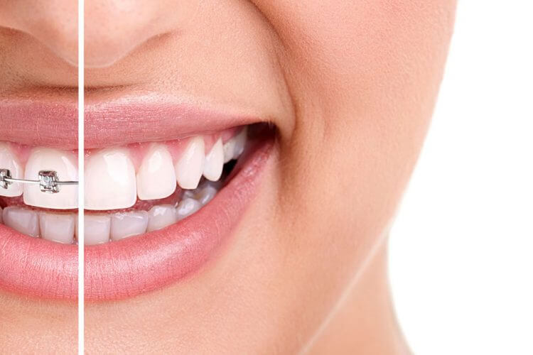 Hızlı Diş Teli Tedavisi