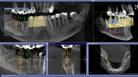 Dijital diş implantları