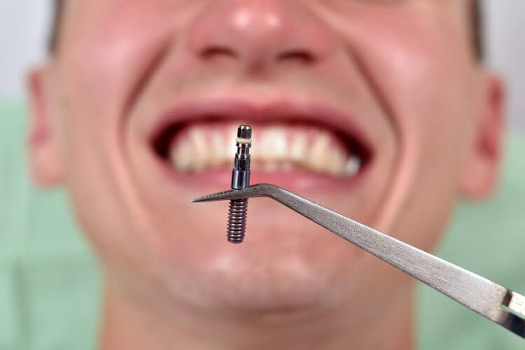 Mini Dental İmplantlar