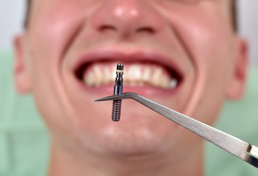 Mini Dental İmplantlar